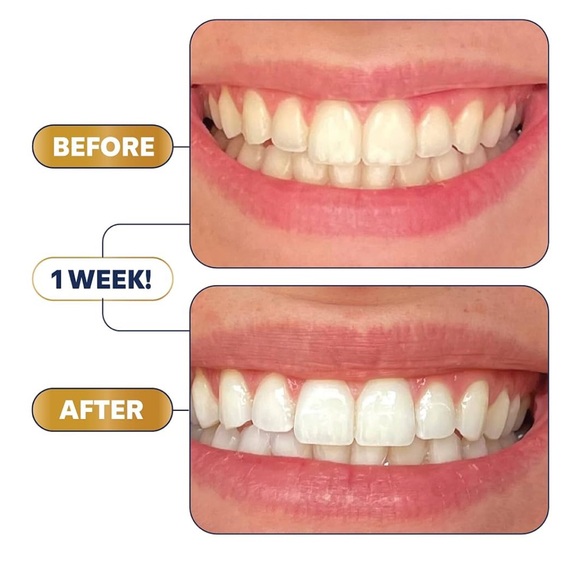 Lumineux 2-in-1 Bright Pen Dual Action Teeth Whitening Set - Picture 5 of 5